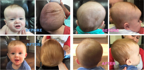 osteopathic treatment torticollis and plagiocephaly