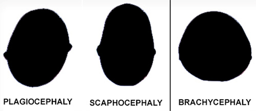 plagiocephaly Osteopathic Healing Hands