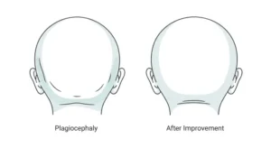 flat head syndrome before and after treatement